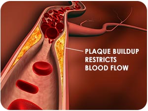 Calcium deposits cause plaque to form blocking blood flow